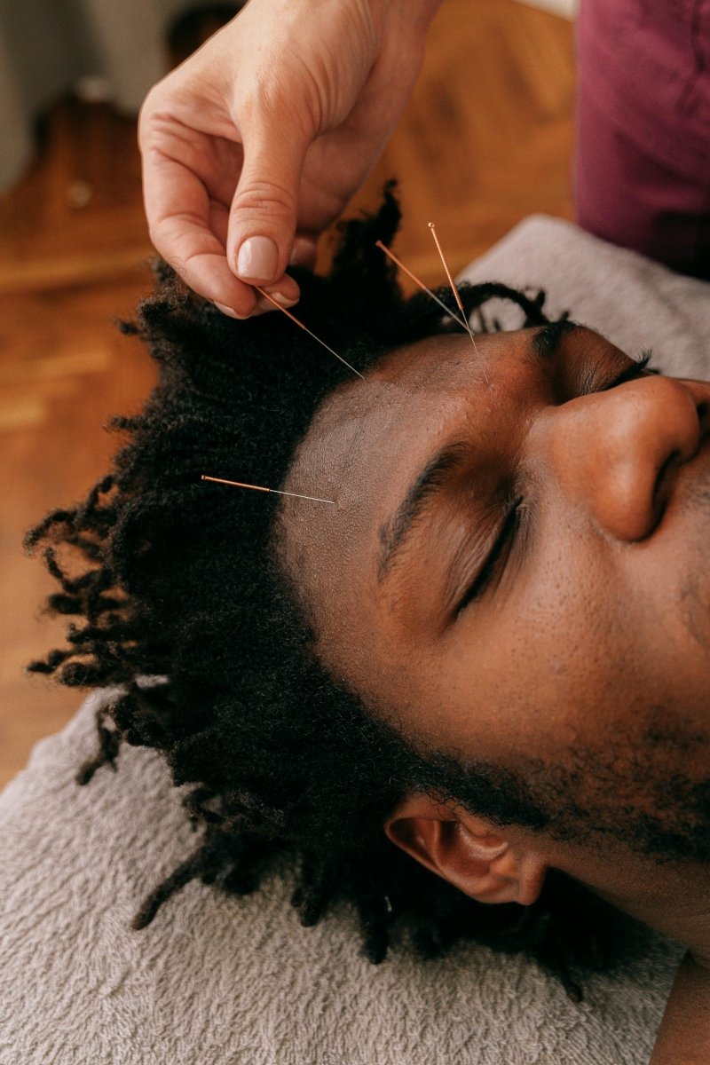 Acupuntura facial: la alternativa natural para rejuvenecer tu piel - Facial Fitness