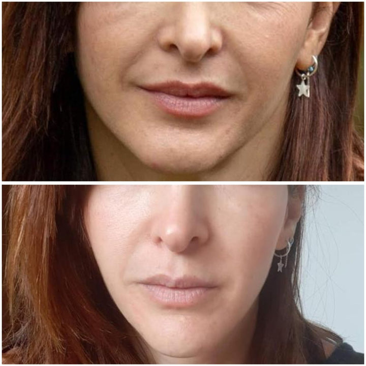 Curso Rejuvenecimiento facial - facial fitness