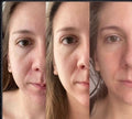 Rejuvenecimiento facial total