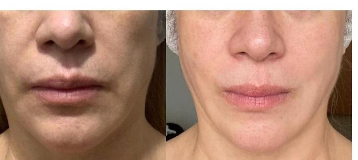 Curso Rejuvenecimiento facial total