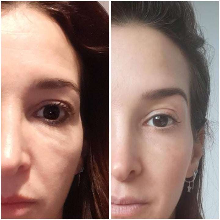 Curso Rejuvenecimiento facial total