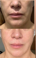 Rejuvenecimiento facial total