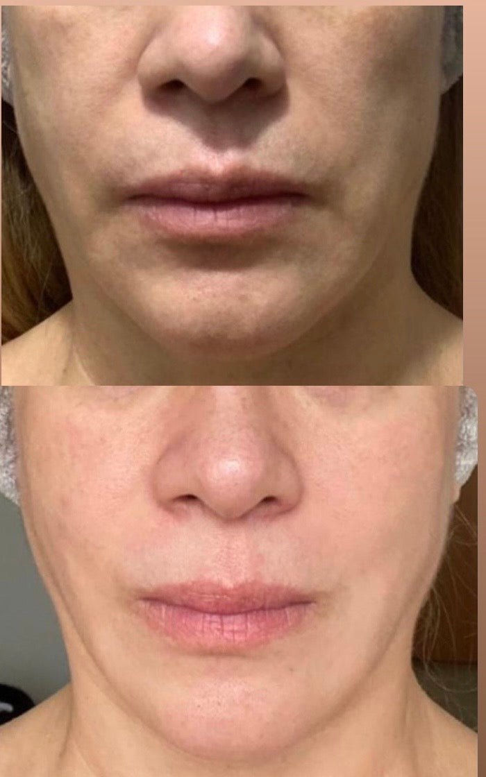 Curso Rejuvenecimiento facial total | Todos nuestros cursos - Facial Fitness