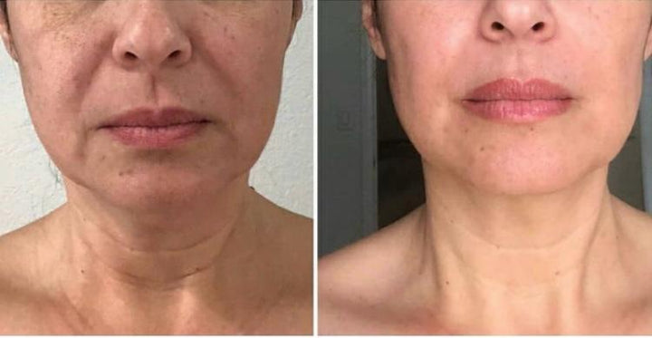 Curso Rejuvenecimiento facial total